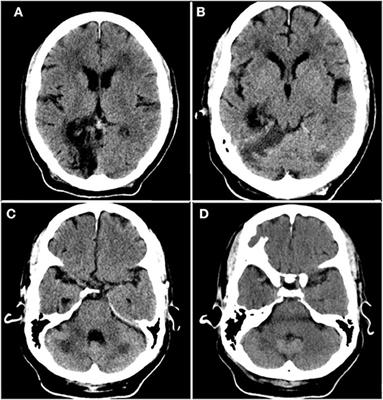 Unfractionated Heparin in SARS-CoV-2 Pneumonia: Ischemic Stroke Case Report